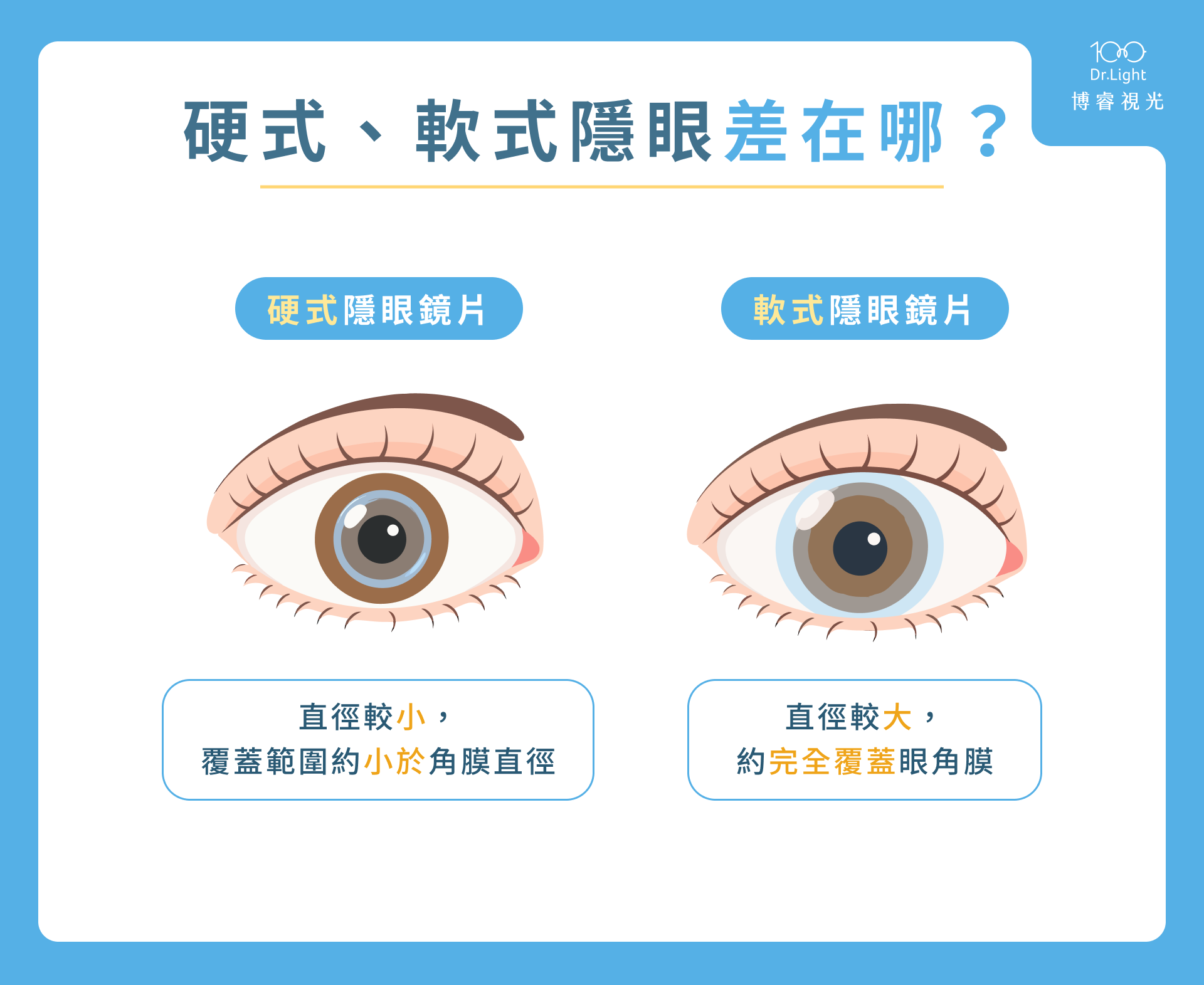 硬式、軟式隱眼差在哪？